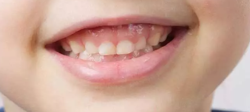 لیست بهترین مراکز درمان لبخند لثه ای شیراز + هزینه درمان لبخند لثه ای
