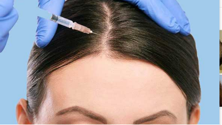 لیست بهترین مراکز مزوتراپی مو در کرج + هزینه مزوتراپی مو
