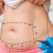 لیست بهترین مراکز لیپوماتیک در شیراز + هزینه لیپوماتیک