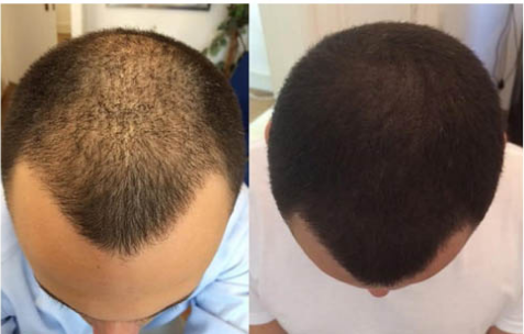 لیست بهترین مراکز میکرو اسکالپ در شیراز + هزینه میکرو اسکالپ