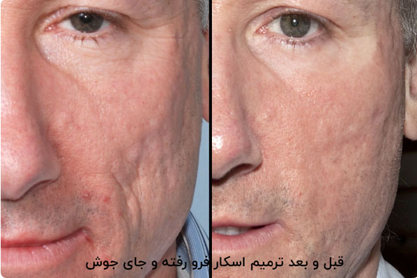 لیست بهترین مراکز درمان اسکار در شیراز + هزینه درمان اسکار