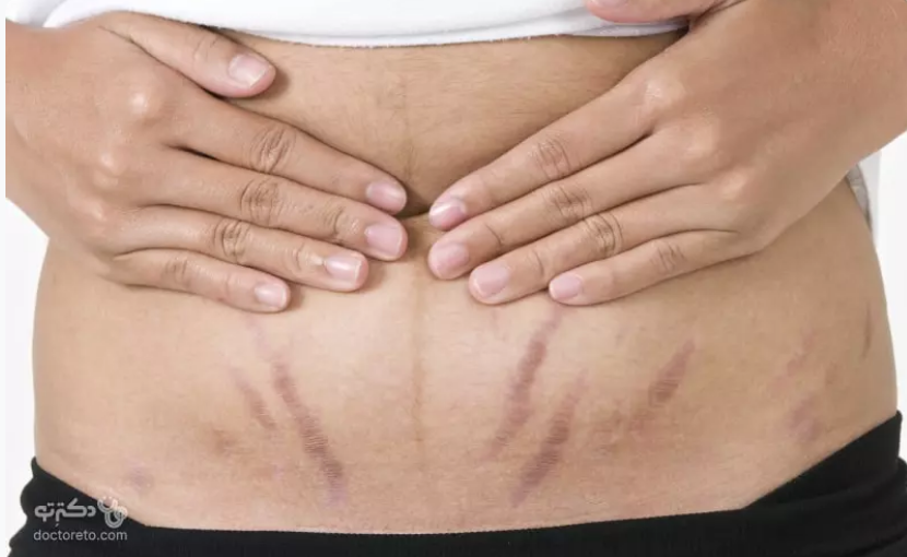 لیست بهترین مراکز رفع ترک پوستی در شیراز + هزینه رفع ترک پوستی