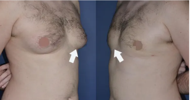 لیست بهترین مراکز عمل ژنیکوماستی در شیراز + هزینه عمل ژنیکوماستی