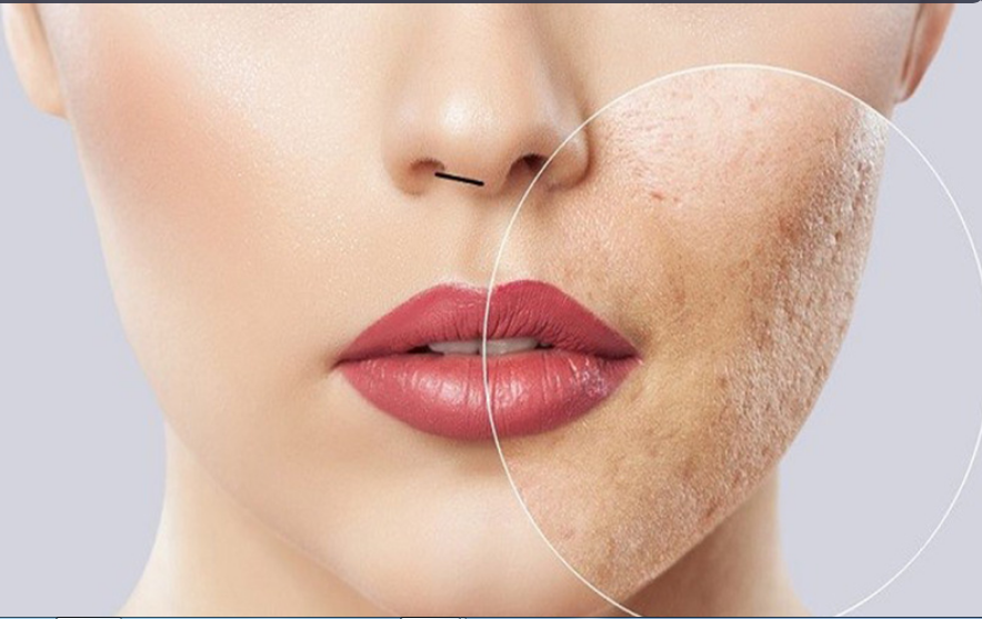 لیست بهترین مراکز مزوتراپی صورت در فرمانیه + هزینه مزوتراپی صورت