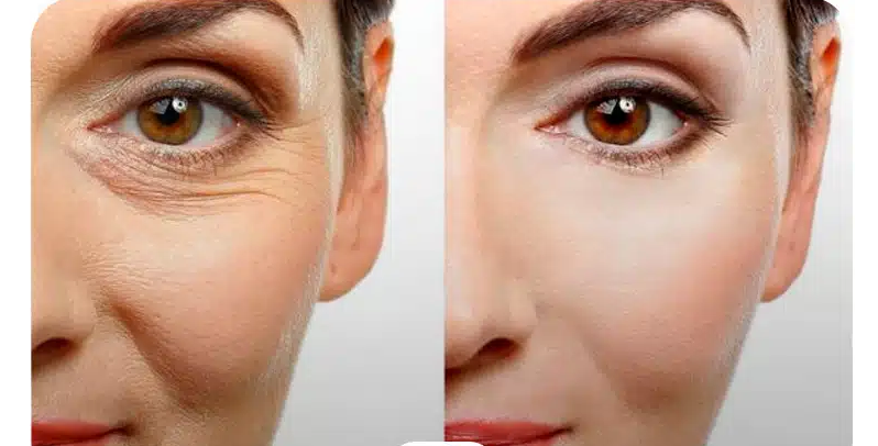 لیست بهترین مراکز تزریق بوتاکس در فرمانیه + هزینه تزریق بوتاکس