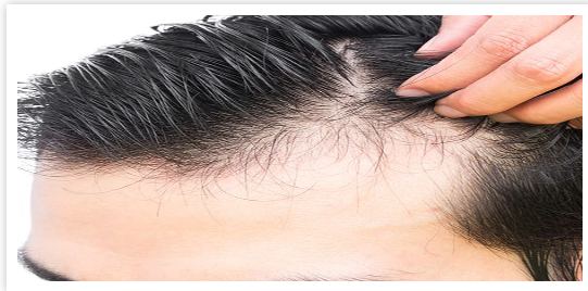 لیست بهترین مراکز کاشت مو در فرمانیه + هزینه کاشت مو