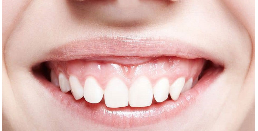 لیست بهترین مراکز درمان لبخند لثه ای در کازرون + هزینه درمان لبخند لثه ای