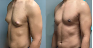لیست بهترین مراکز عمل ژنیکوماستی در فرمانیه + هزینه عمل ژنیکوماستی 1402
