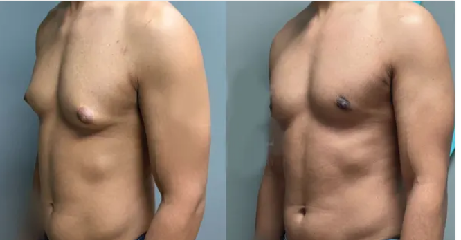 لیست بهترین مراکز عمل ژنیکوماستی در فرمانیه + هزینه عمل ژنیکوماستی