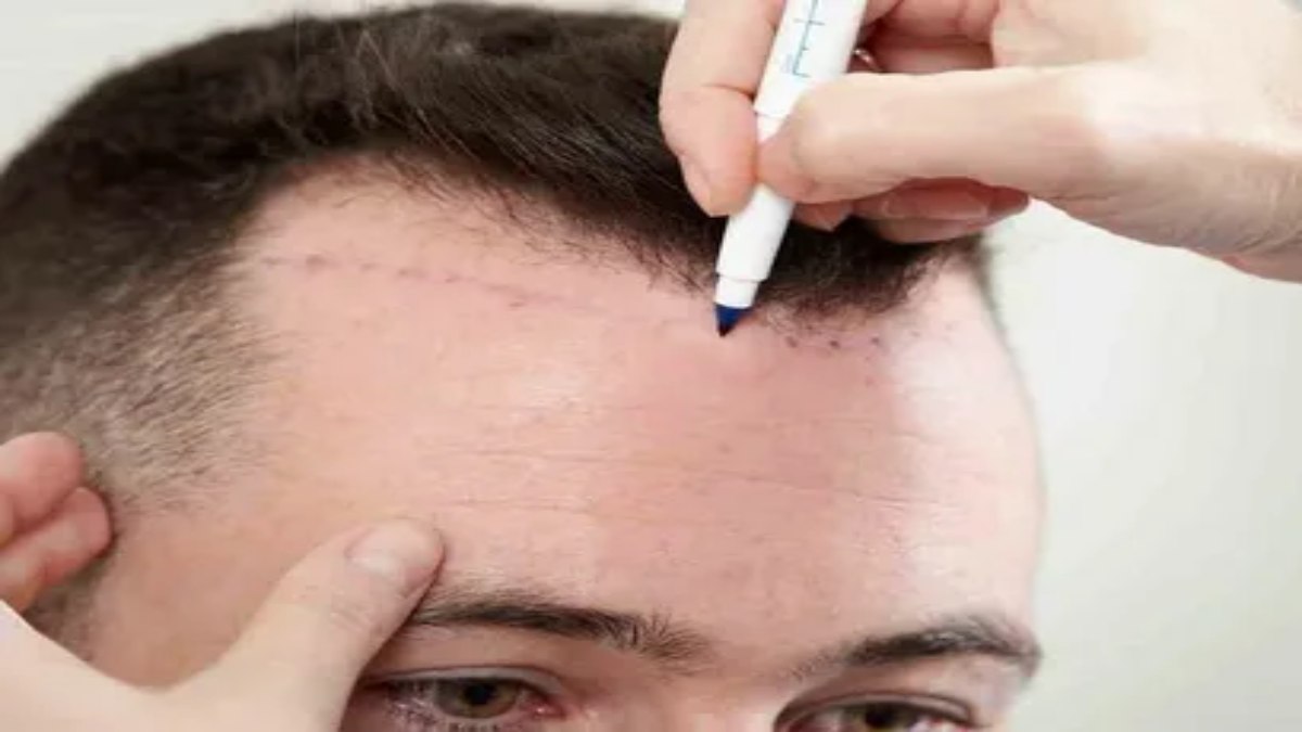 لیست بهترین مراکز کاشت مو در آباده + هزینه کاشت مو