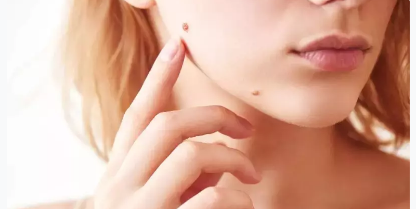 لیست بهترین مراکز برداشتن خال در مرودشت + هزینه برداشتن خال