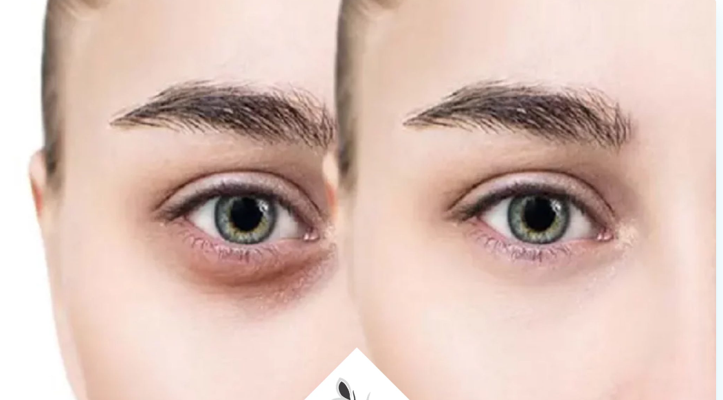 لیست بهترین مراکز کربوکسی تراپی در داراب + هزینه کربوکسی تراپی