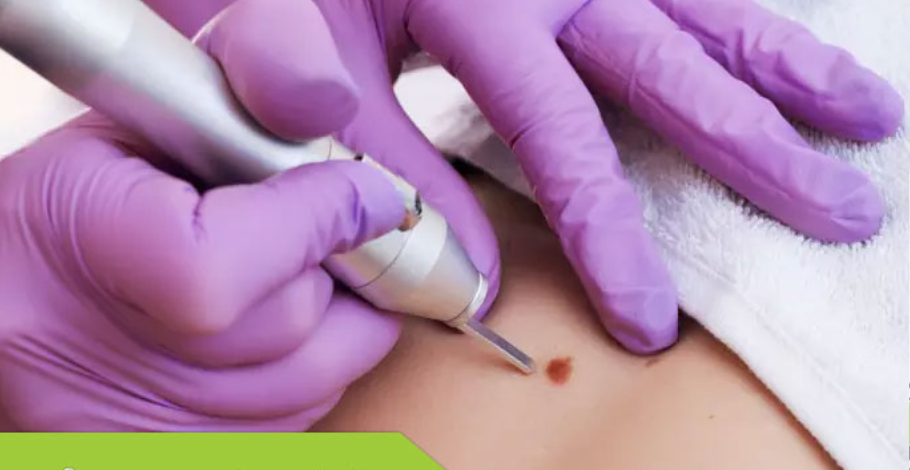لیست بهترین مراکز کرایوتراپی در نی ریز + هزینه کرایوتراپی