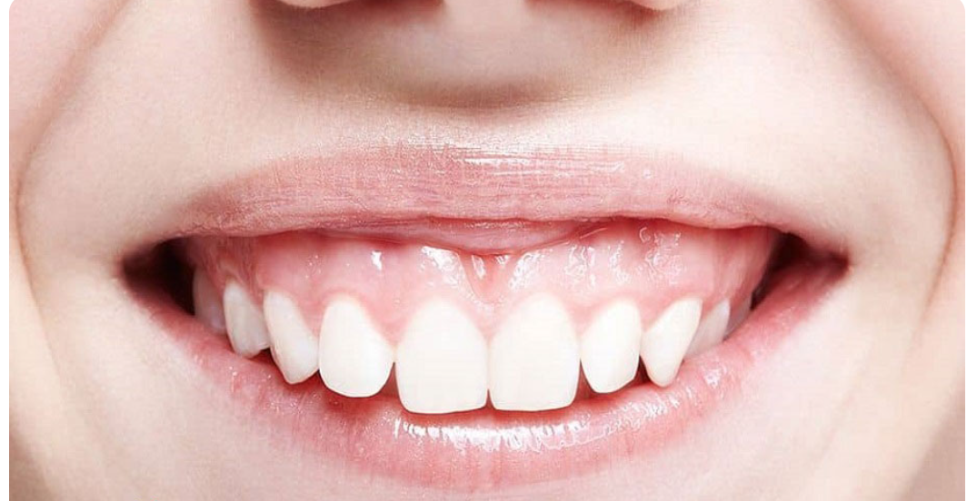 لیست بهترین مراکز درمان لبخند لثه ای در نی ریز + هزینه درمان لبخند لثه ای