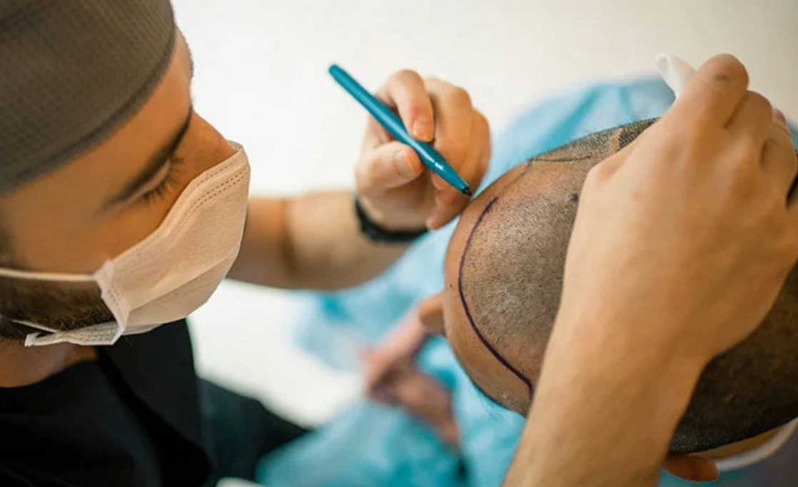 لیست بهترین مراکز کاشت مو در اقلید + هزینه کاشت مو
