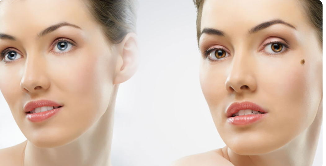 لیست بهترین مراکز برداشتن خال در نی ریز + هزینه برداشتن خال