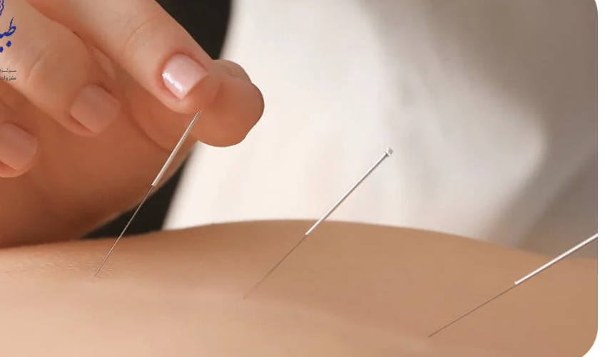 لیست بهترین مراکز طب سوزنی در استهبان + هزینه طب سوزنی