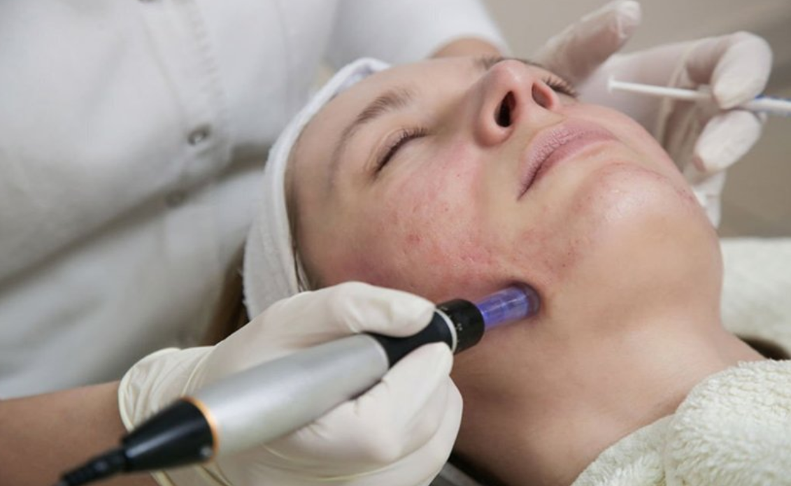 لیست بهترین مراکز میکرونیدلینگ در استهبان + هزینه میکرونیدلینگ