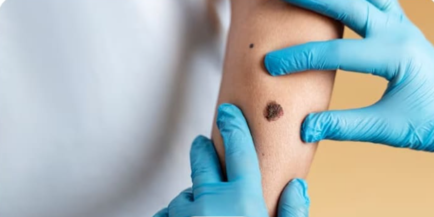 لیست بهترین مراکز برداشتن خال در استهبان + هزینه برداشتن خال