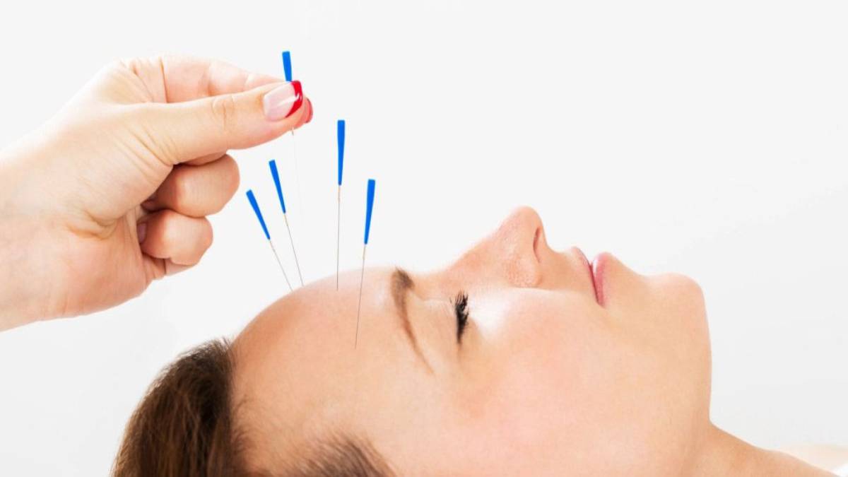 لیست بهترین مراکز طب سوزنی در اندرزگو + هزینه طب سوزنی
