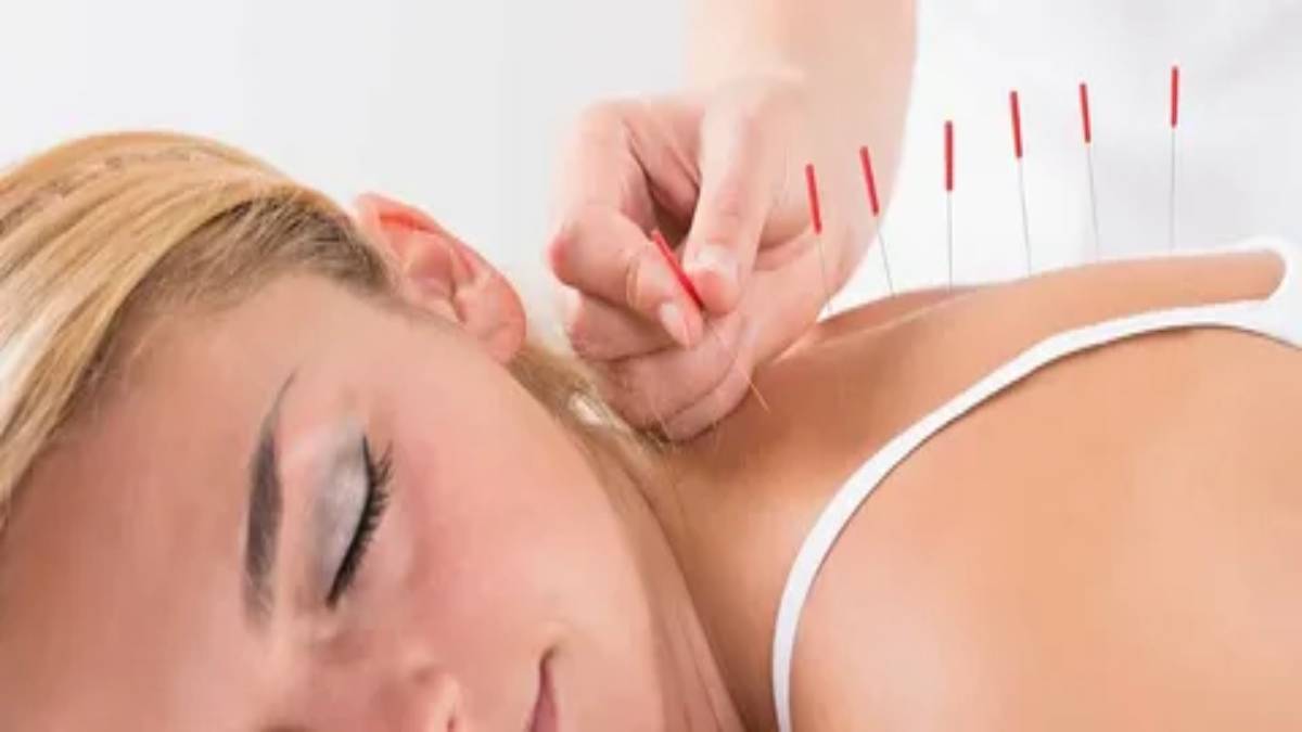 لیست بهترین مراکز طب سوزنی در تجریش + هزینه طب سوزنی