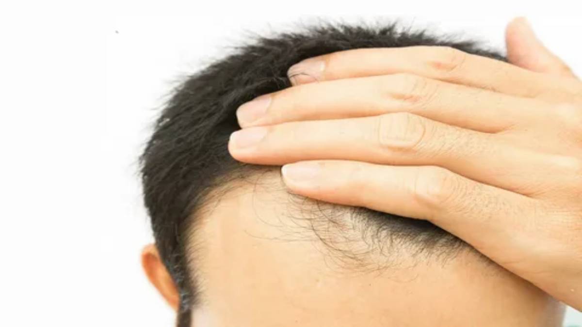لیست بهترین مراکز درمان ریزش مو در تجریش + هزینه درمان ریزش مو