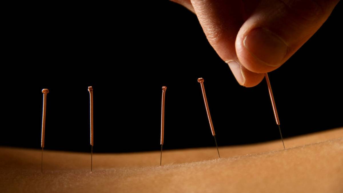 لیست بهترین مراکز طب سوزنی در ولنجک + هزینه طب سوزنی