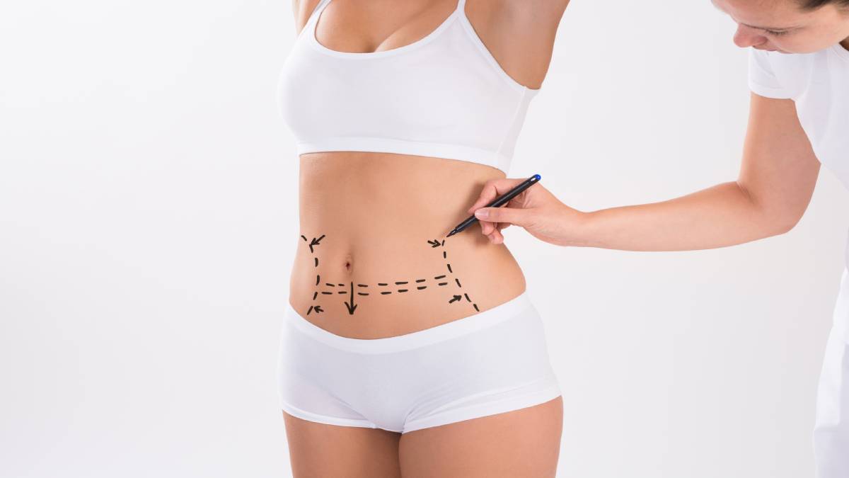 لیست بهترین مراکز ابدومینوپلاستی در فرشته + هزینه ابدومینوپلاستی