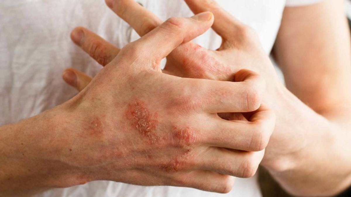 لیست بهترین مراکز درمان اگزما در فرشته + هزینه درمان اگزما