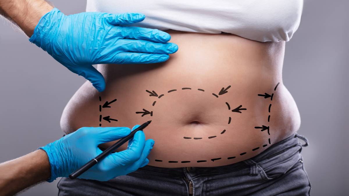 لیست بهترین مراکز لیپوماتیک در فرشته + هزینه لیپوماتیک