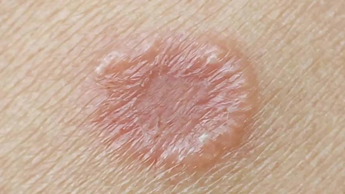 لیست بهترین مراکز درمان قارچ پوستی در فرشته + هزینه قارچ پوستی