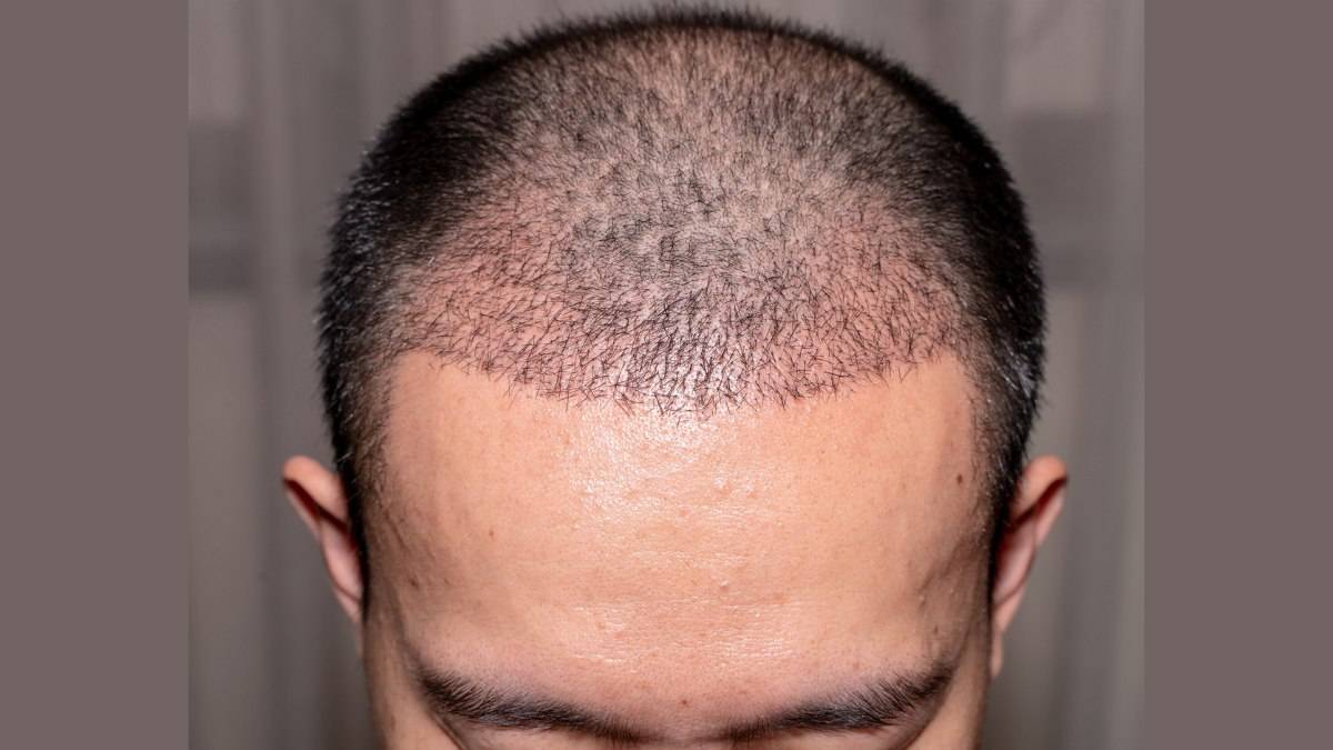 لیست بهترین مراکز کاشت مو در منظریه + هزینه کاشت مو
