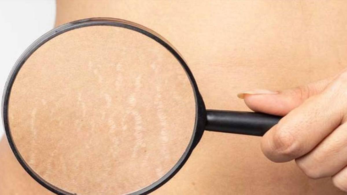 لیست بهترین مراکز درمان ترک پوستی در فرشته + هزینه درمان ترک پوستی