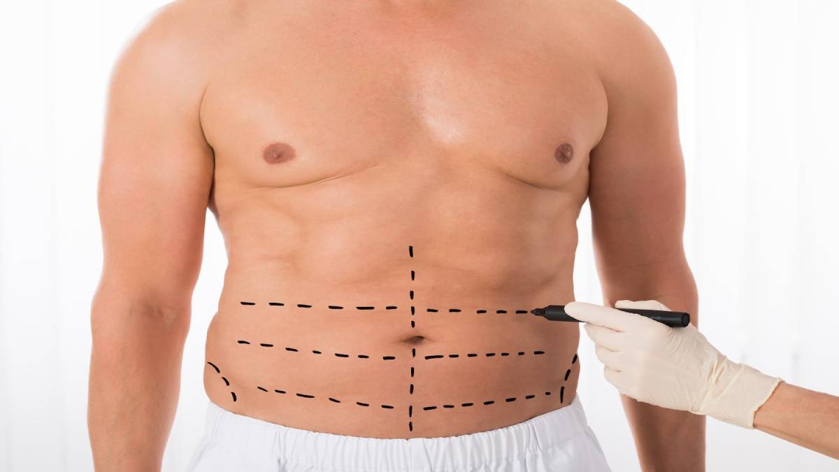 لیست بهترین مراکز لیپوساکشن در منظریه + هزینه لیپوساکشن