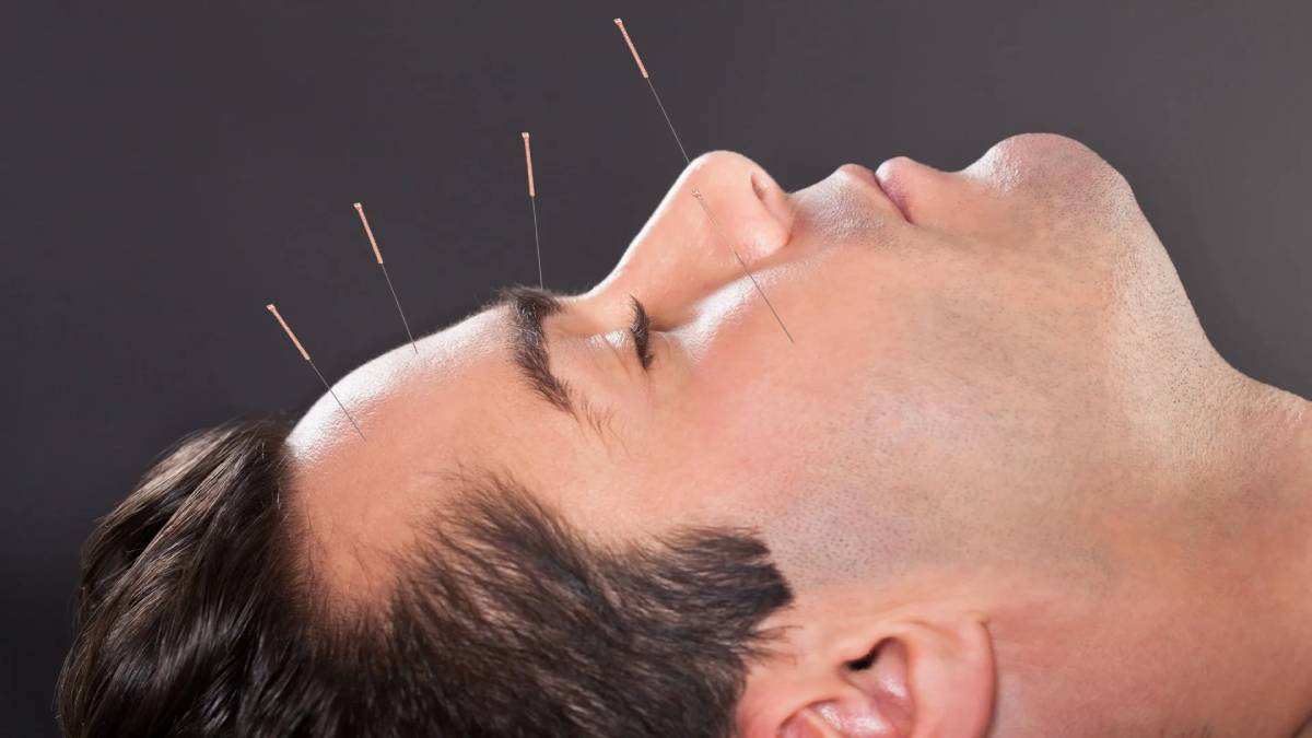 لیست بهترین مراکز طب سوزنی در اقدسیه + هزینه طب سوزنی