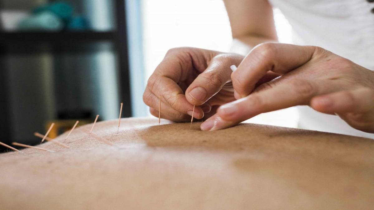 لیست بهترین مراکز طب سوزنی در سعادت آباد + هزینه طب سوزنی
