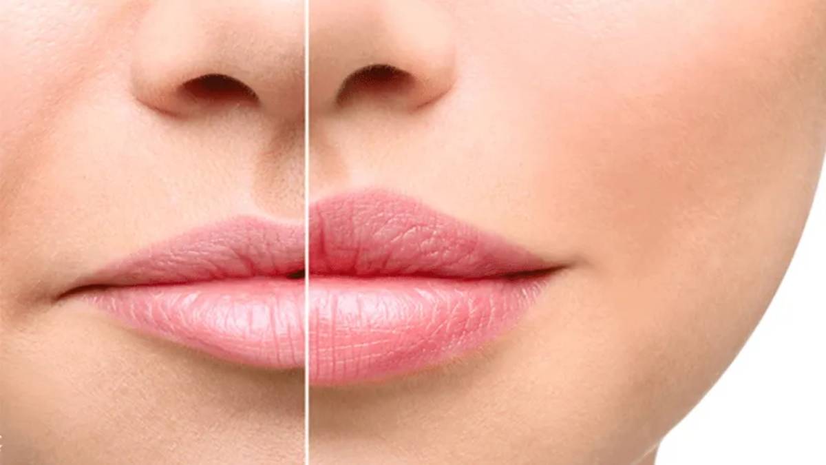 لیست بهترین مراکز لیفت سانترال لب در سعادت آباد + هزینه لیفت سانترال لب