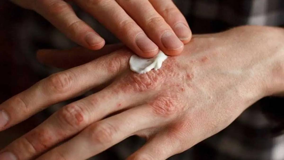 لیست بهترین مراکز درمان اگزما در سعادت آباد + هزینه درمان اگزما