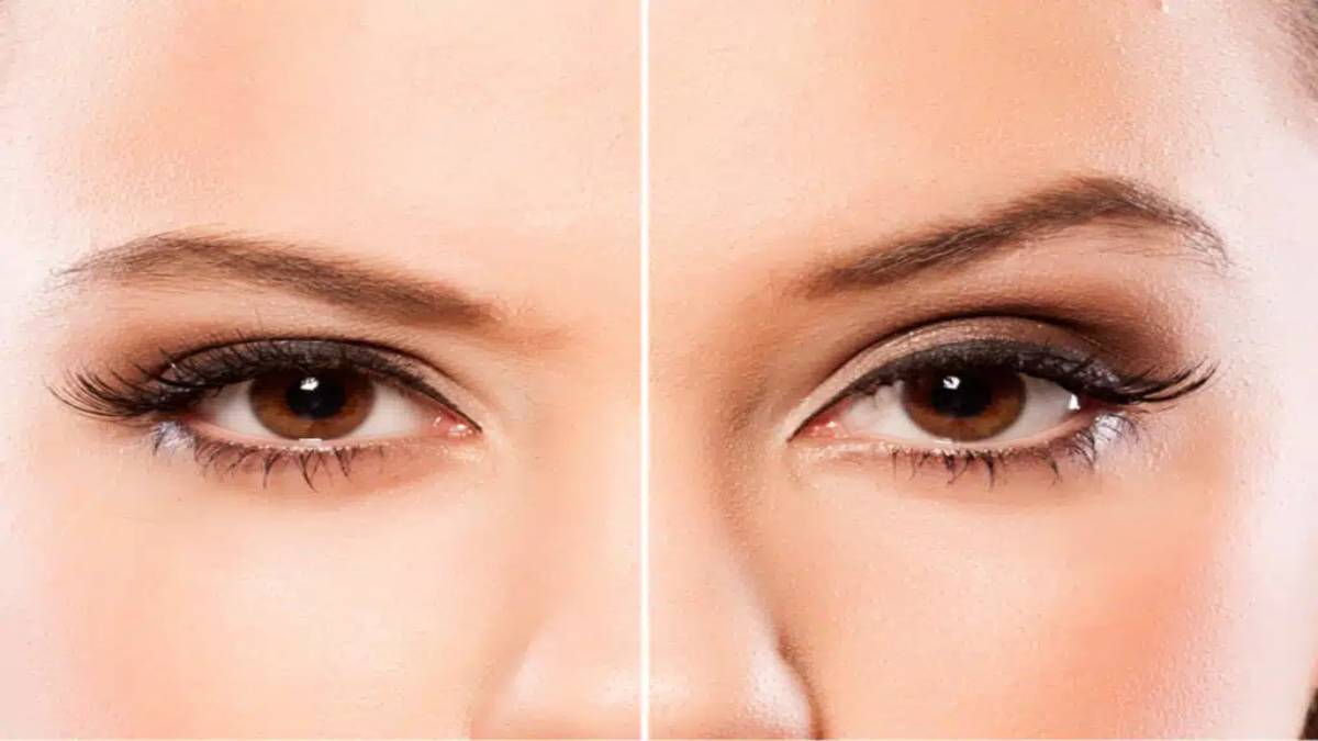 لیست بهترین مراکز جراحی لیفت ابرو در سعادت آباد + هزینه جراحی لیفت ابرو