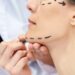لیست بهترین مراکز جراحی چانه در سعادت آباد + هزینه جراحی چانه