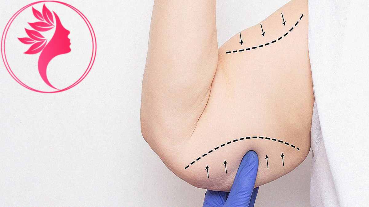 لیست بهترین مراکز جراحی لیفت بازو در شهرک غرب + هزینه جراحی لیفت بازو