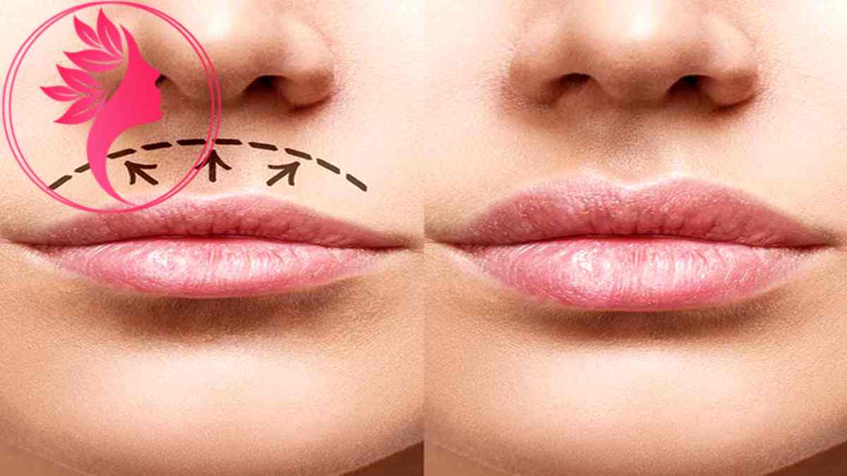 لیست بهترین مراکز لیفت سانترال لب در شهرک غرب + هزینه لیفت سانترال لب