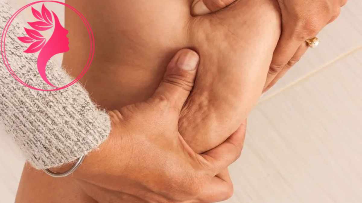 لیست بهترین مراکز درمان سلولیت در گیشا + هزینه درمان سلولیت