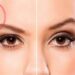 لیست بهترین مراکز جراحی لیفت ابرو در گیشا + هزینه جراحی لیفت ابرو