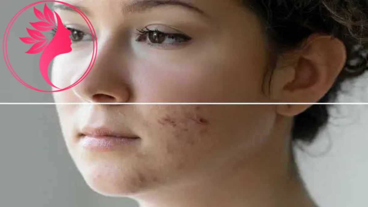 لیست بهترین مراکز درمان اسکار در گیشا + هزینه درمان اسکار
