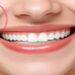 لیست بهترین مراکز درمان لبخند لثه ای در گیشا + هزینه درمان لبخند لثه ای