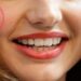 لیست بهترین مراکز کاشت چال گونه در گیشا + هزینه کاشت چال گونه