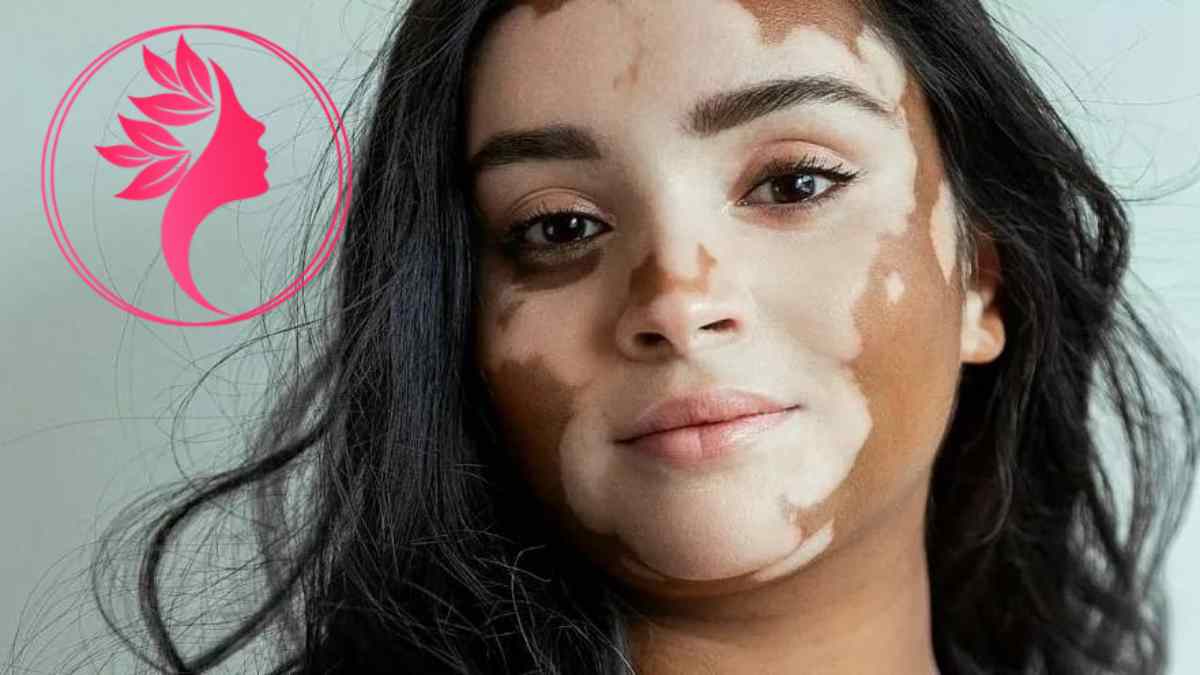 لیست بهترین مراکز درمان پیسی در گیشا + هزینه درمان پیسی
