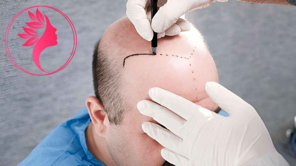 لیست بهترین مراکز کاشت مو در آجودانیه + هزینه کاشت مو