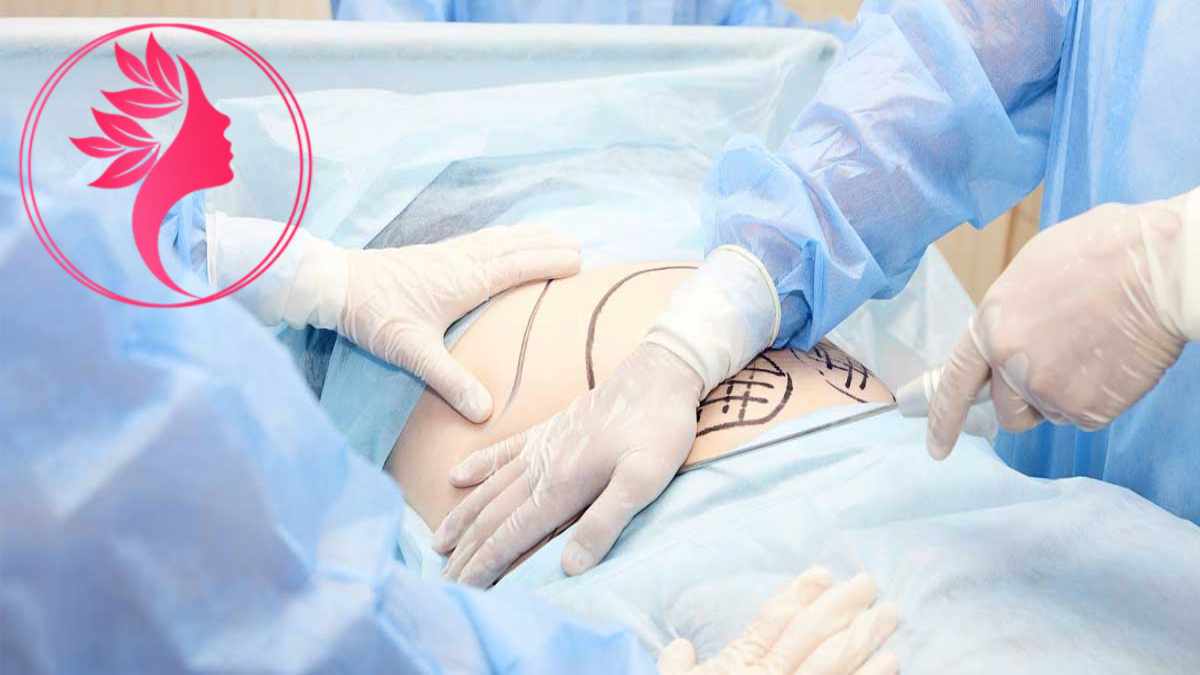 لیست بهترین مراکز ابدومینوپلاستی در آجودانیه + هزینه ابدومینوپلاستی